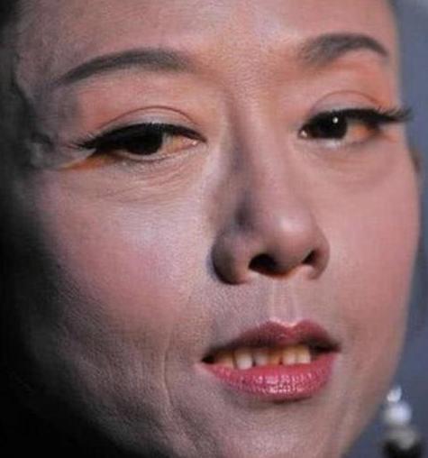 张永主任浅谈拉皮手术拉皮手术只适合中老年人做吗